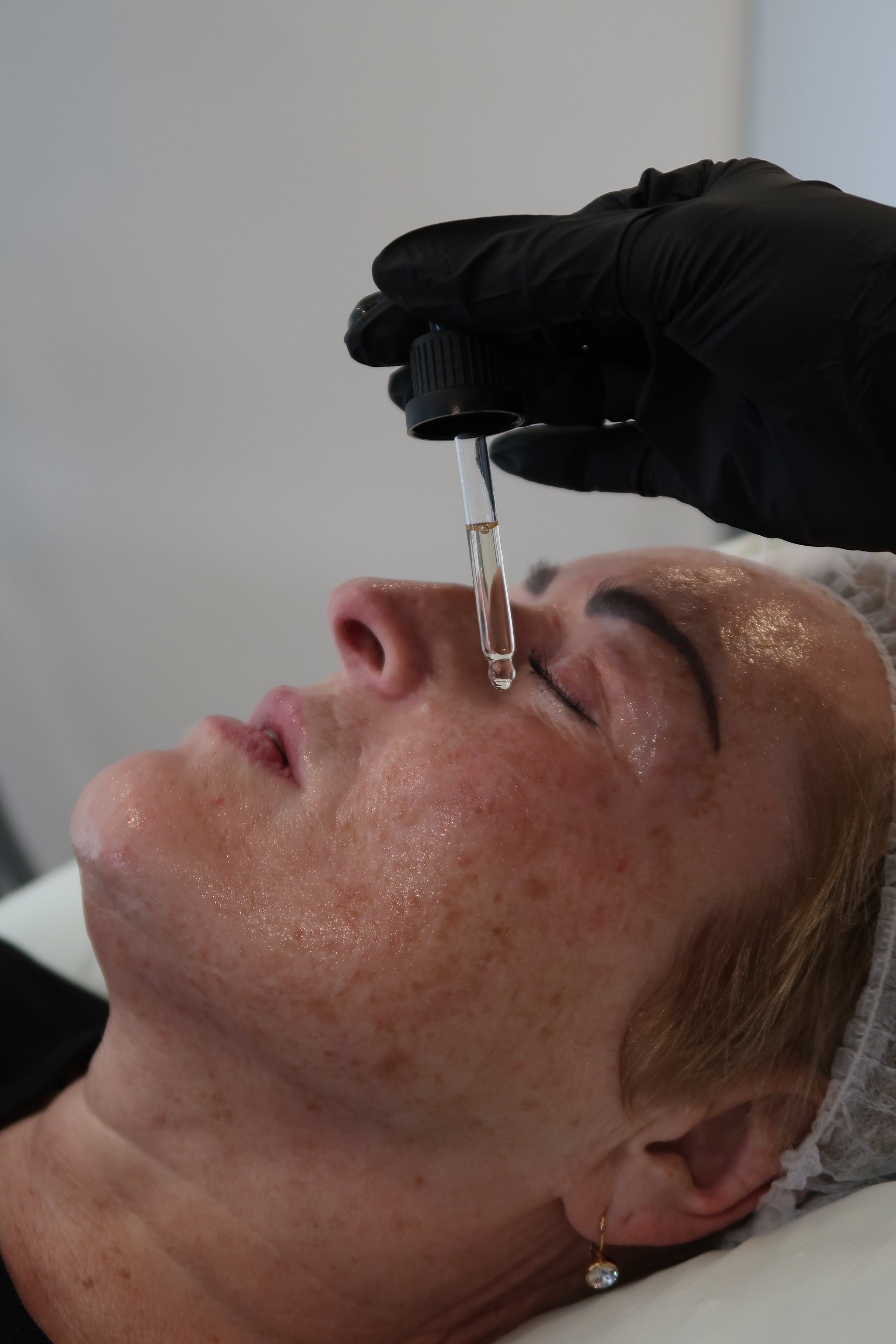 What Is Microneedling? Everything You Need to Know About This Skin Treatment