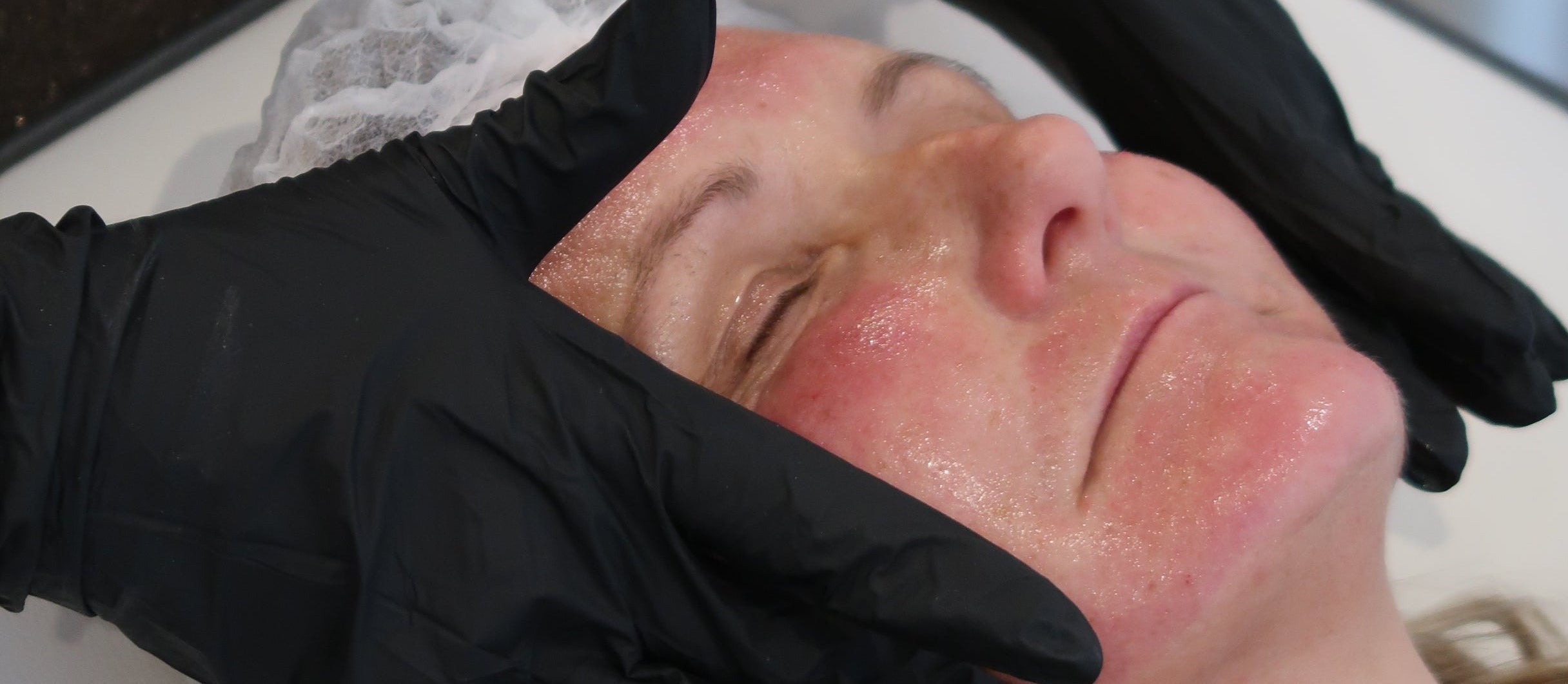 Microneedling: Everything Patients Need to Know Before, During and After Treatment