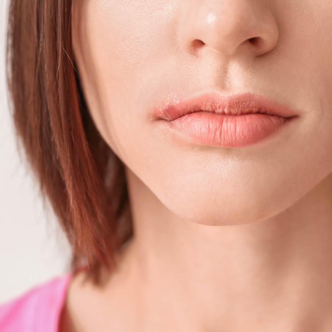 Cold Sore Triggers: What Causes Them & How to Manage Flare-Ups Gently