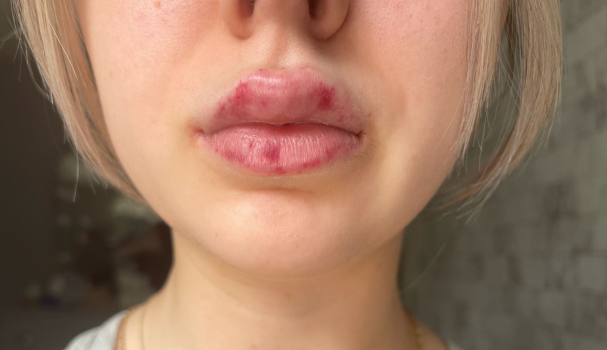 Swelling and bruising of lips after lip procedure