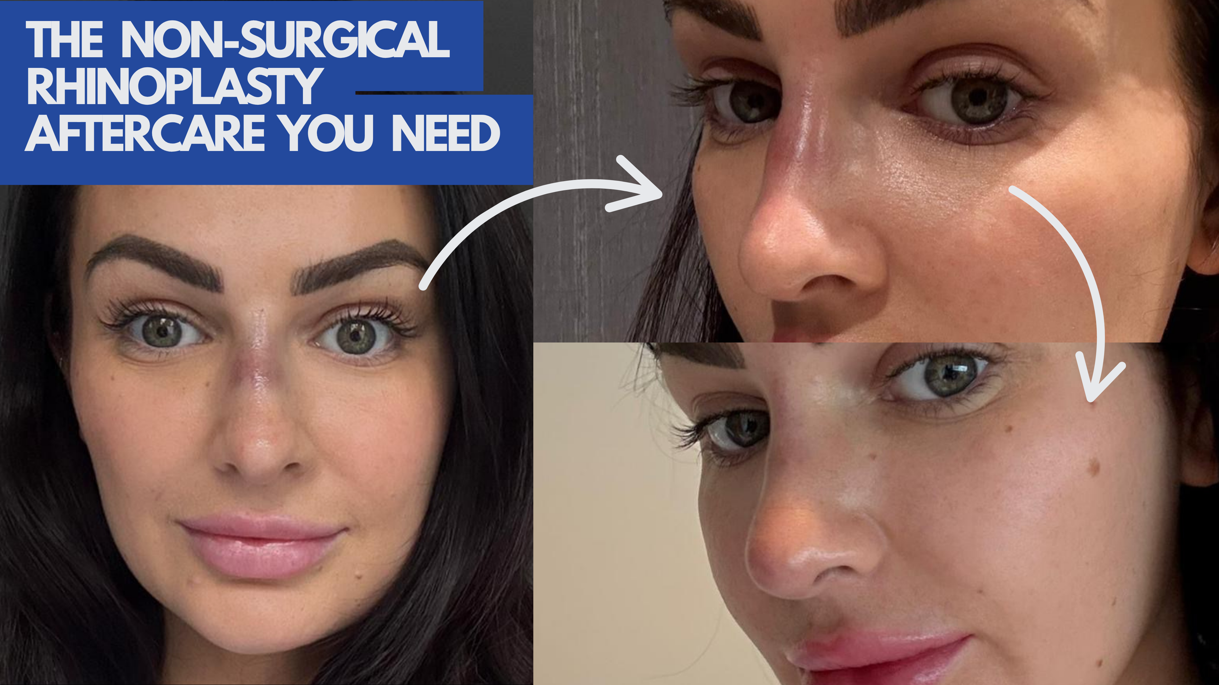 Thinking About Non-Surgical Rhinoplasty? Read this first: