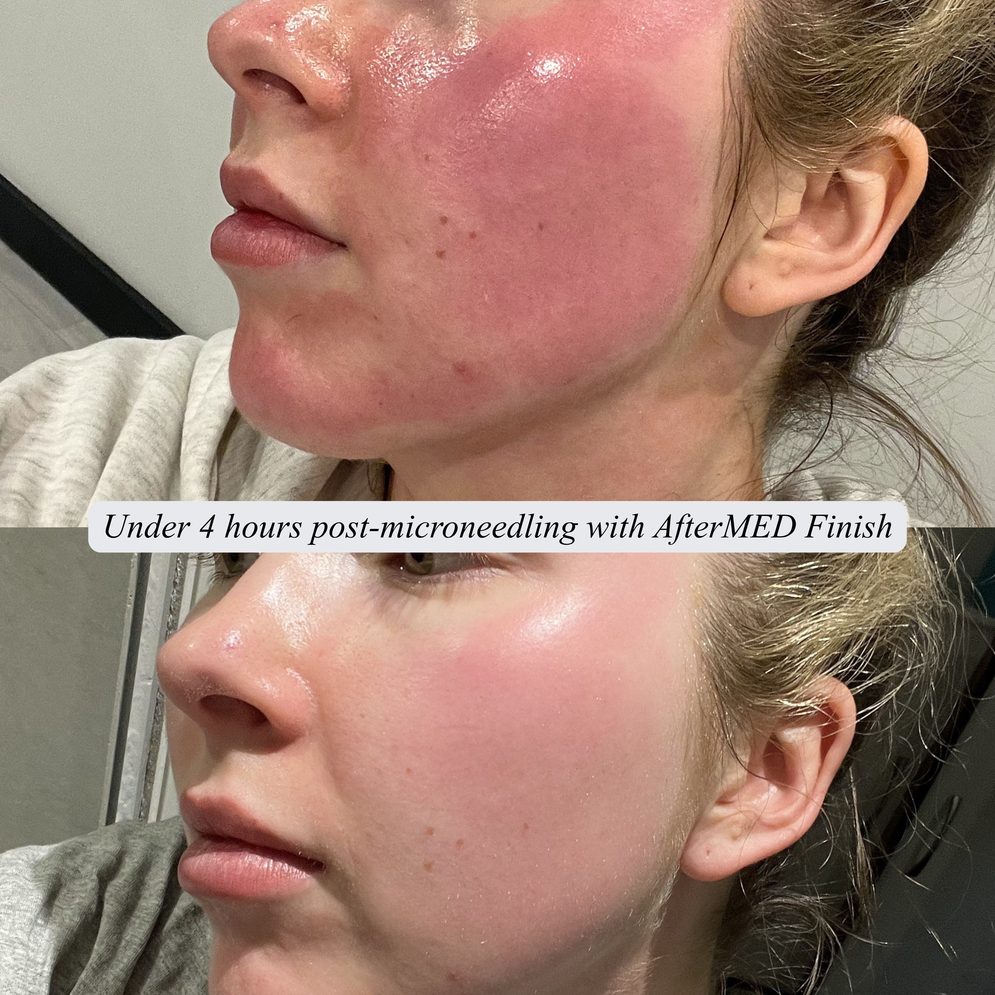 AfterMED Finish - Aftercare For Microneedling