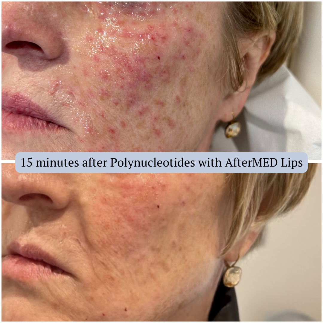 AfterMED Lips - Aftercare For Polynucleotides