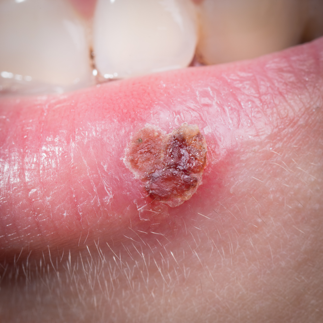 AfterMED Lips - Aftercare For Cold Sores