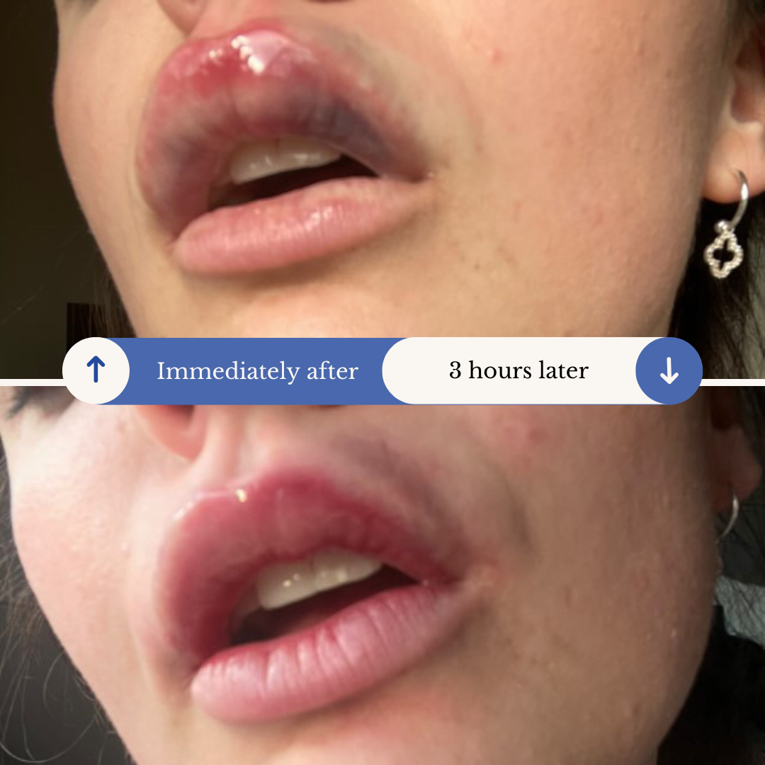 AfterMED Lips - Aftercare For Lip Filler Dissolve