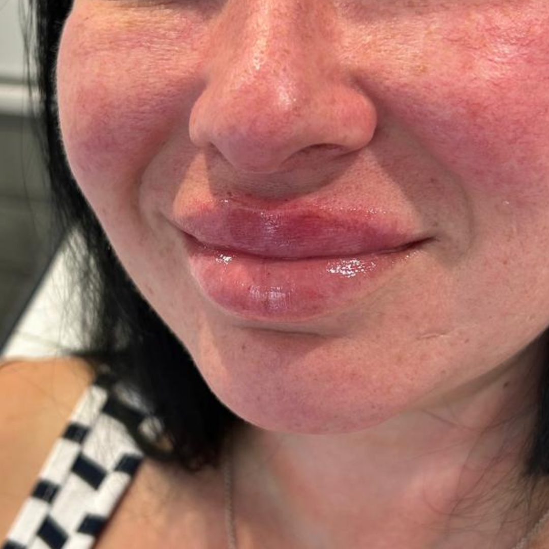 AfterMED Lips - Aftercare For Lip Filler Dissolve