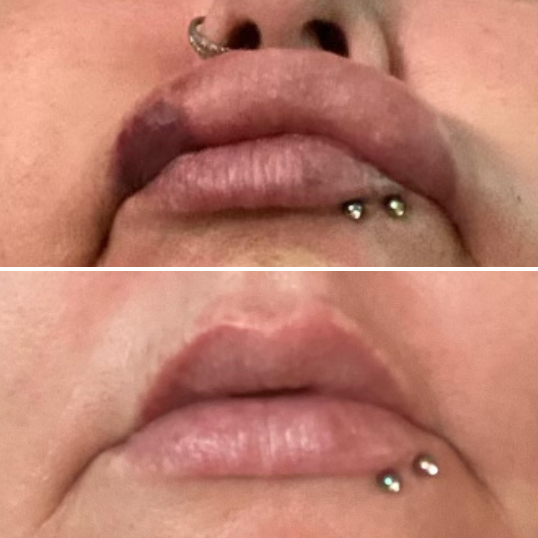AfterMED Lips (+ free clinic headband)