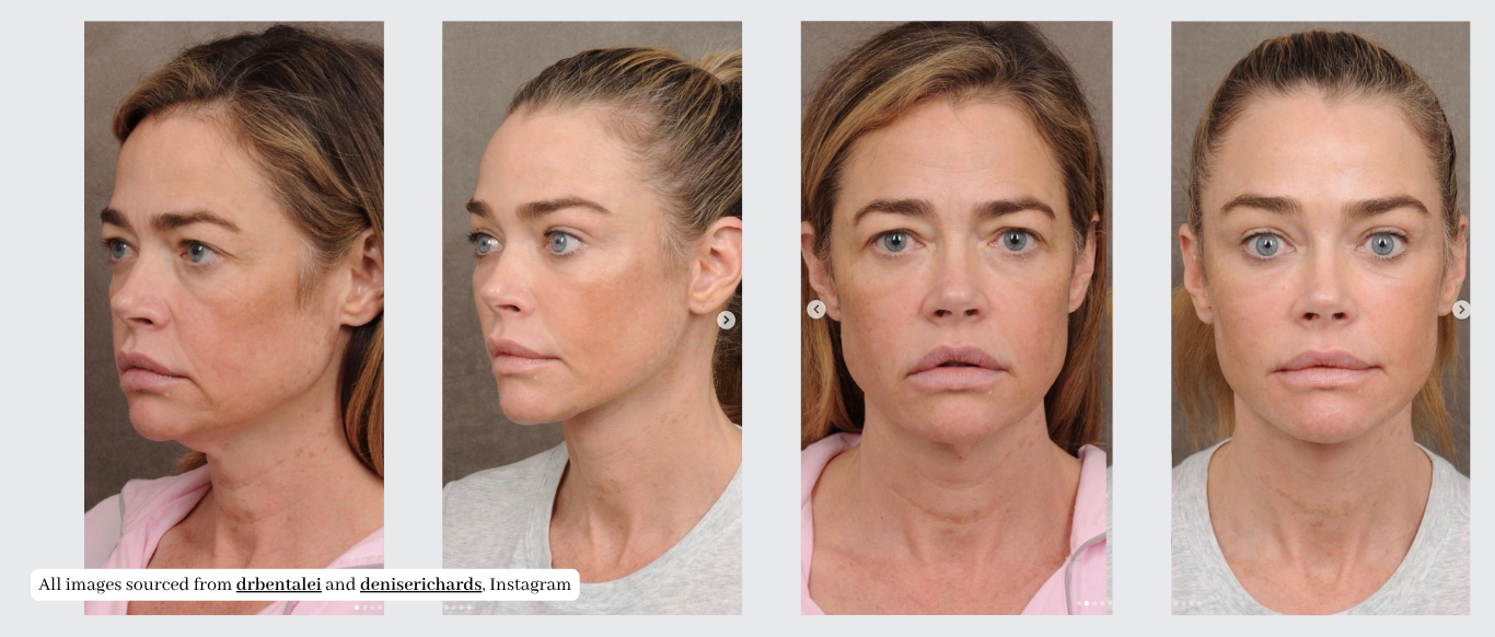 Denise Richards’s Facelift: What She Had Done and What Everyone Wants to Know