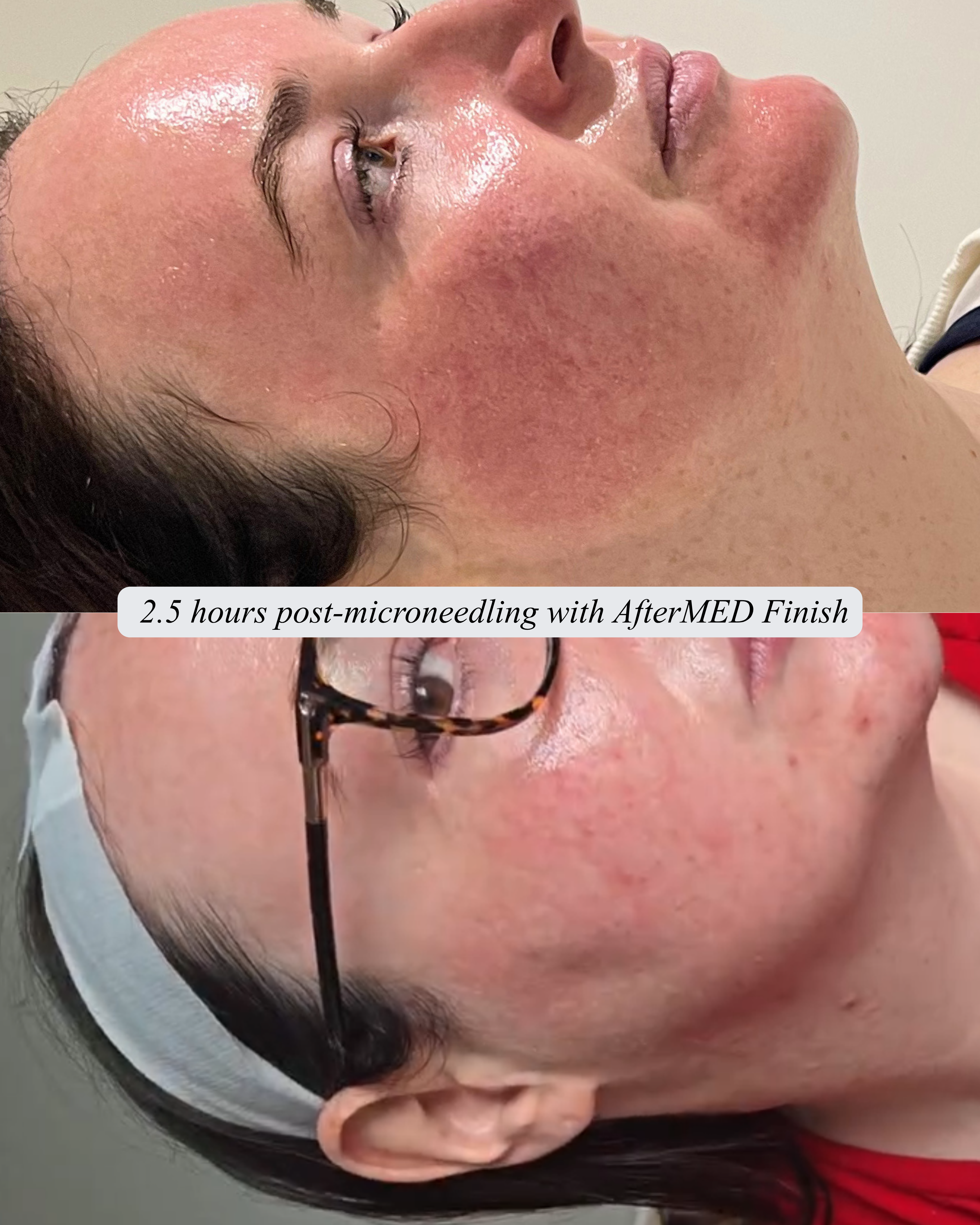 AfterMED Finish - Aftercare For Microneedling