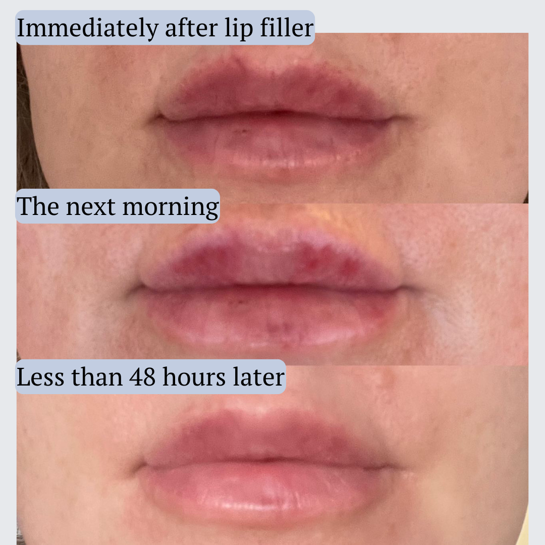 AfterMED Lips (+ free clinic headband)